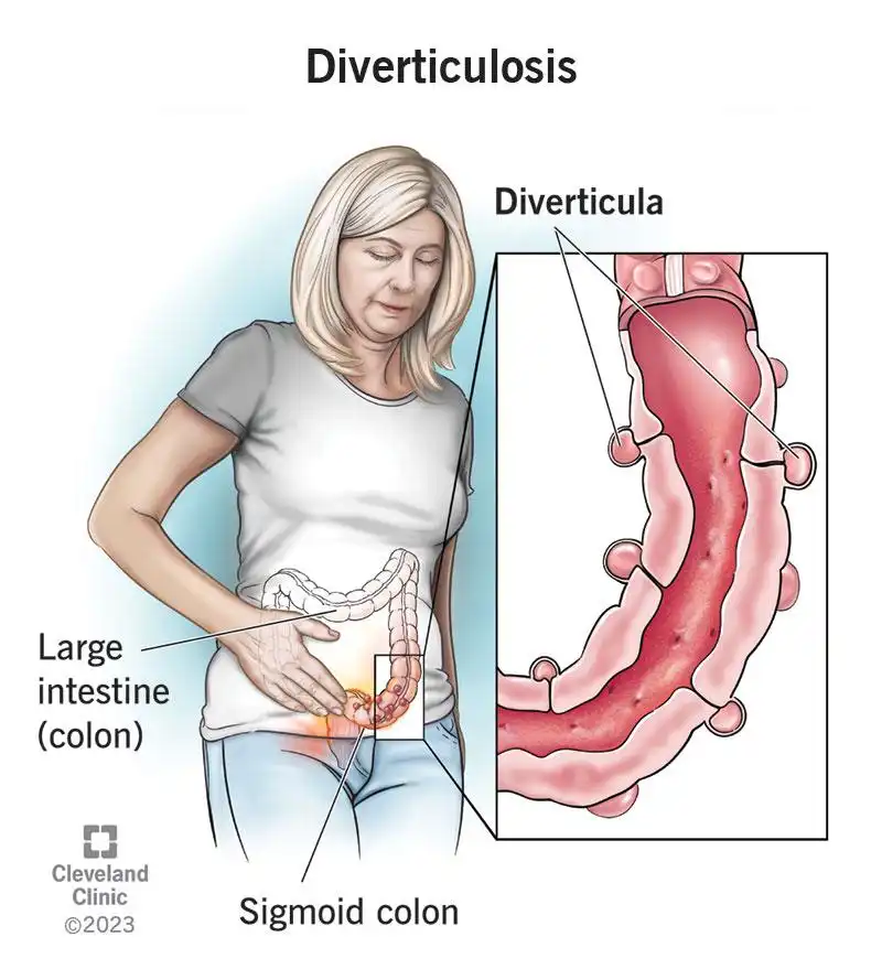 Diverticulitis Poop Images: What Stool Changes May Mean